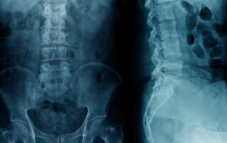 bone spurs on spine