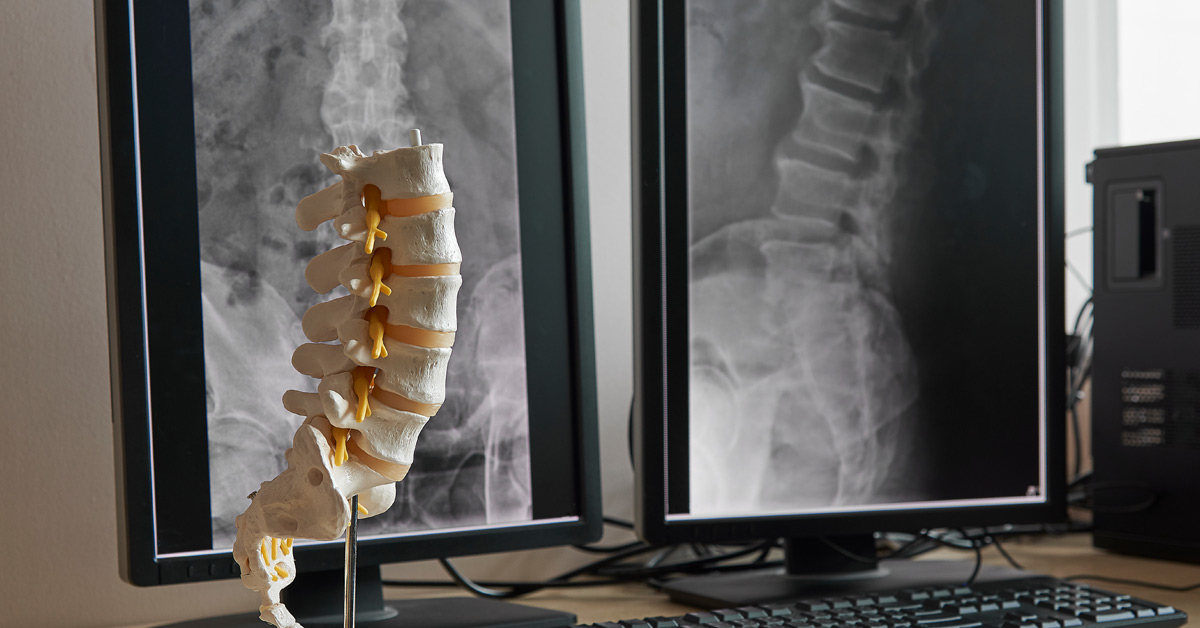 Artificial Lumbar Disc Artificial Lumbar Disc
